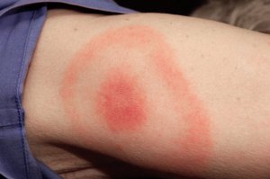 The red bulls-eye rash from a tick bite